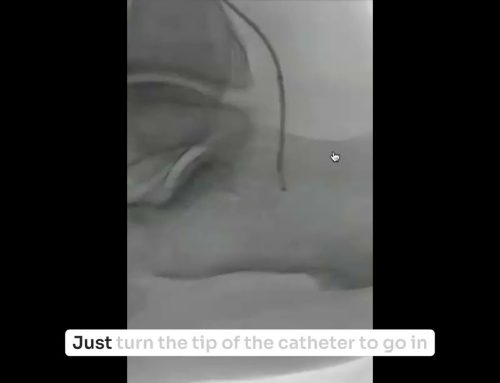 Finding a Path: Foot Recanalization in Low-MAC Disease